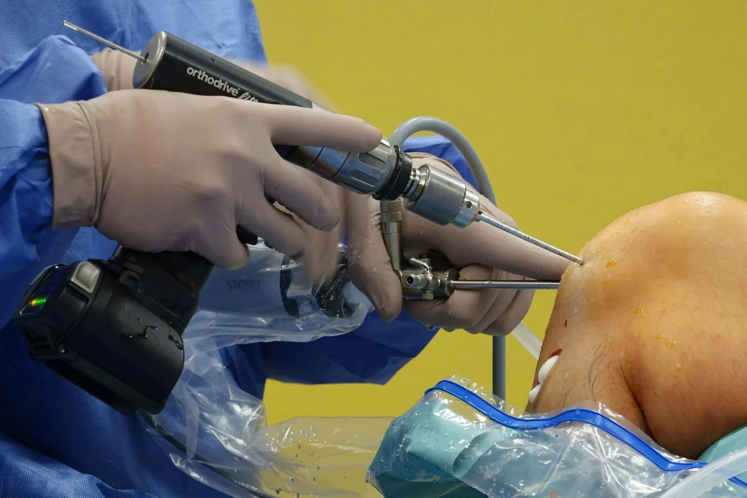 Orthopedic surgeon performing knee surgery in an operating room