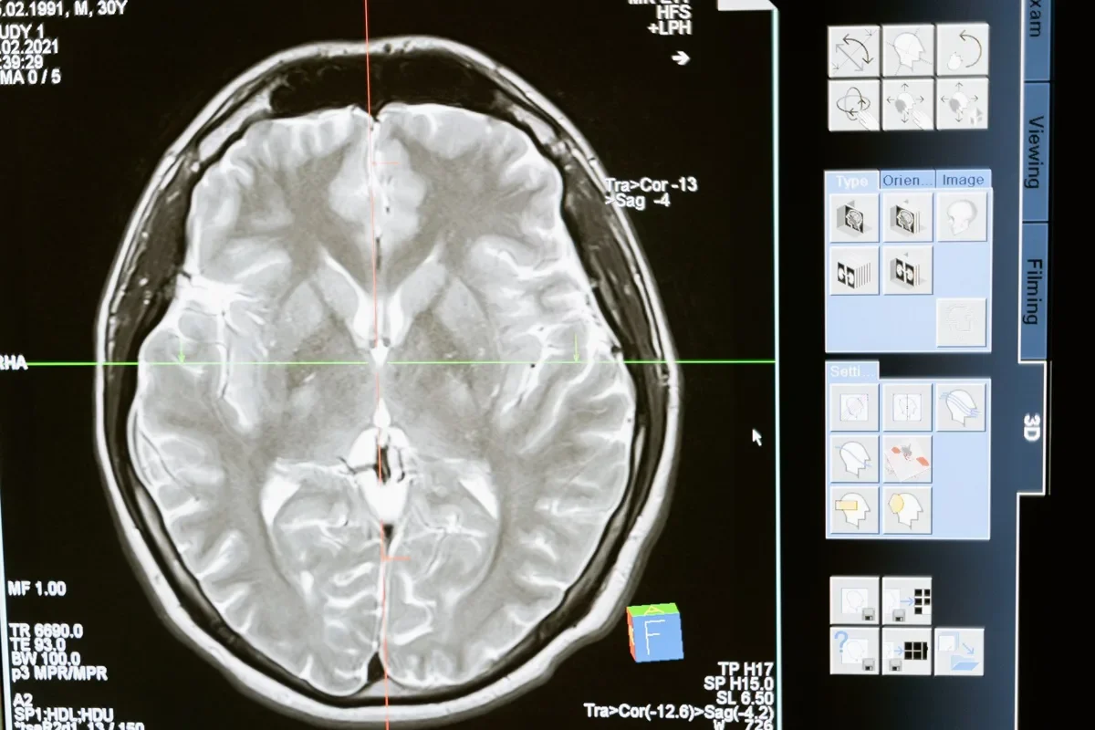 Brain tumor surgery cost in the US