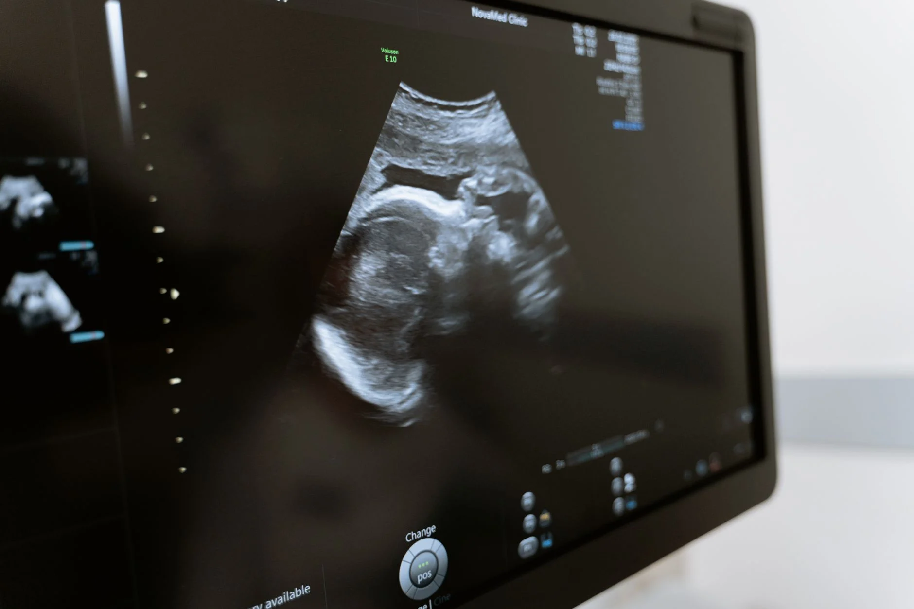 Ultrasound is the first-line imaging test for suspected gallbladder attack